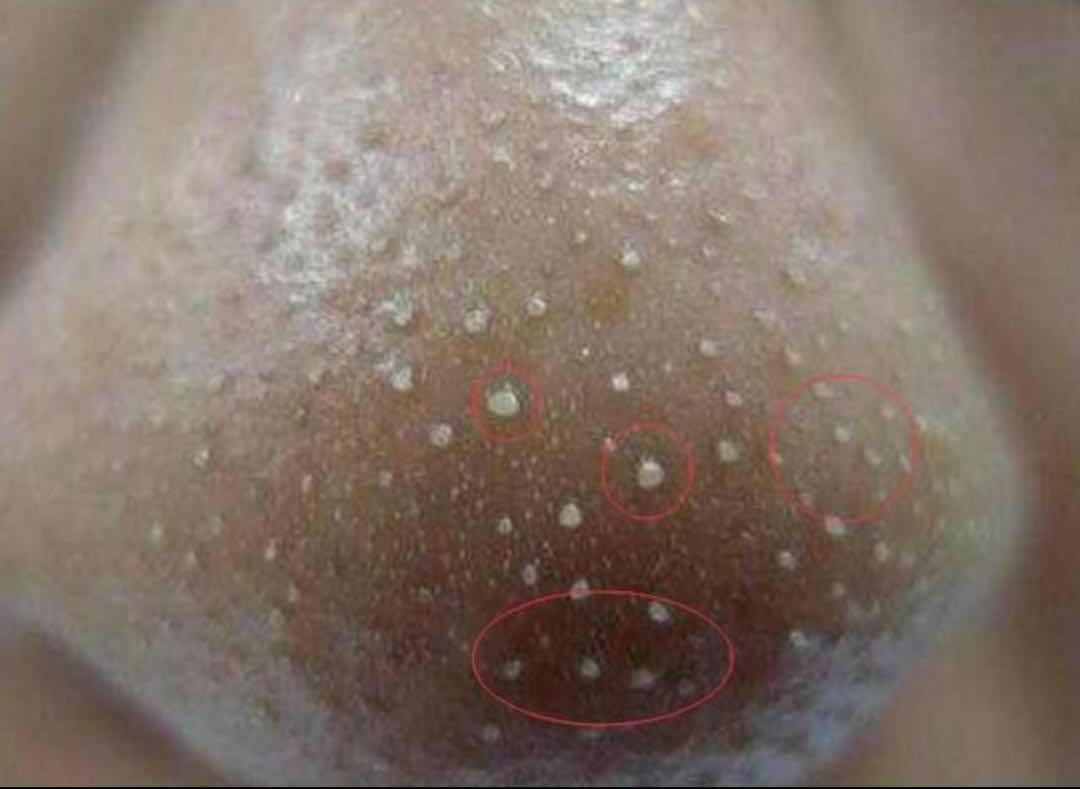 鼻子挤出黄色分泌物是什么,拉出来黄色虫卵是什么虫