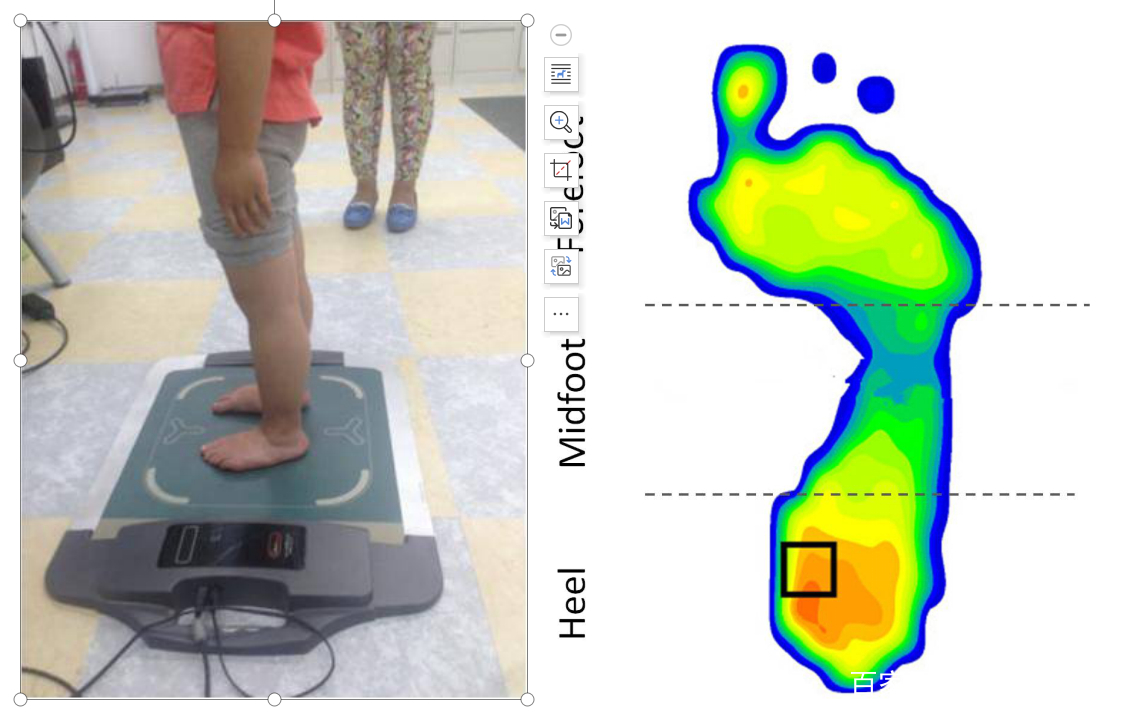 孩子足外翻买什么鞋矫正,儿童足外翻矫正鞋去哪里做