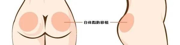 自体脂肪填充全脸逆袭,自体脂肪填充的真相来了