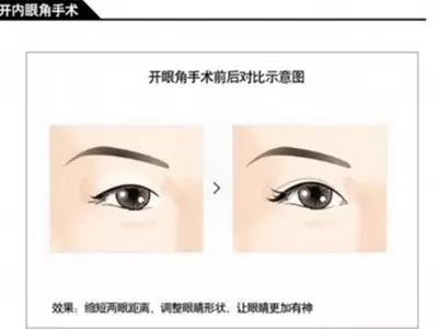 开内眼角会遗留明显疤痕吗,十个开眼角十个留疤