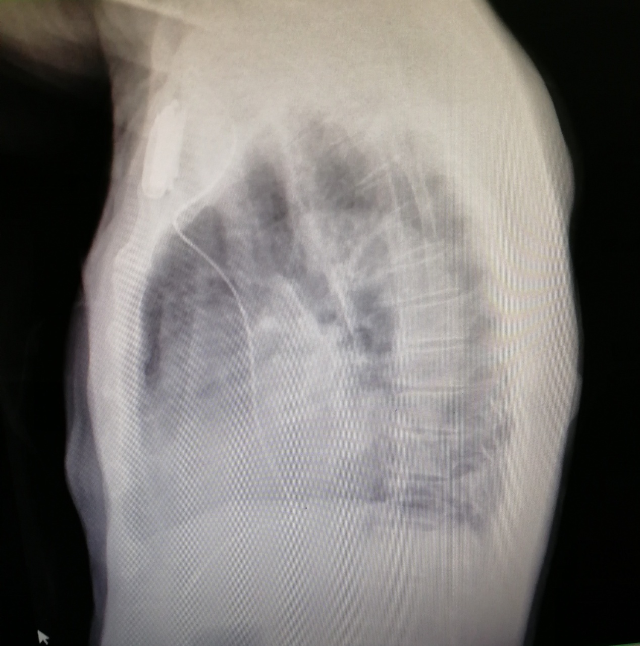 我院心内科援外医生完成圣普首例超声引导下永久心脏起搏器植入术