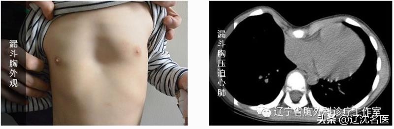 漏斗胸单孔矫正,30成年轻微漏斗胸怎么矫正