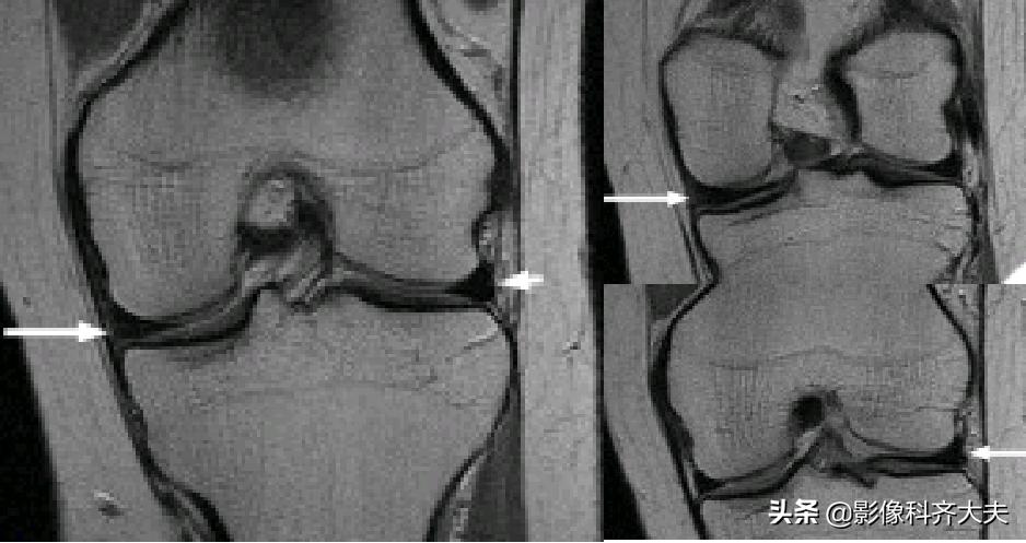 膝关节半月板损伤的磁共振,膝关节半月板病变的mri诊断与鉴别