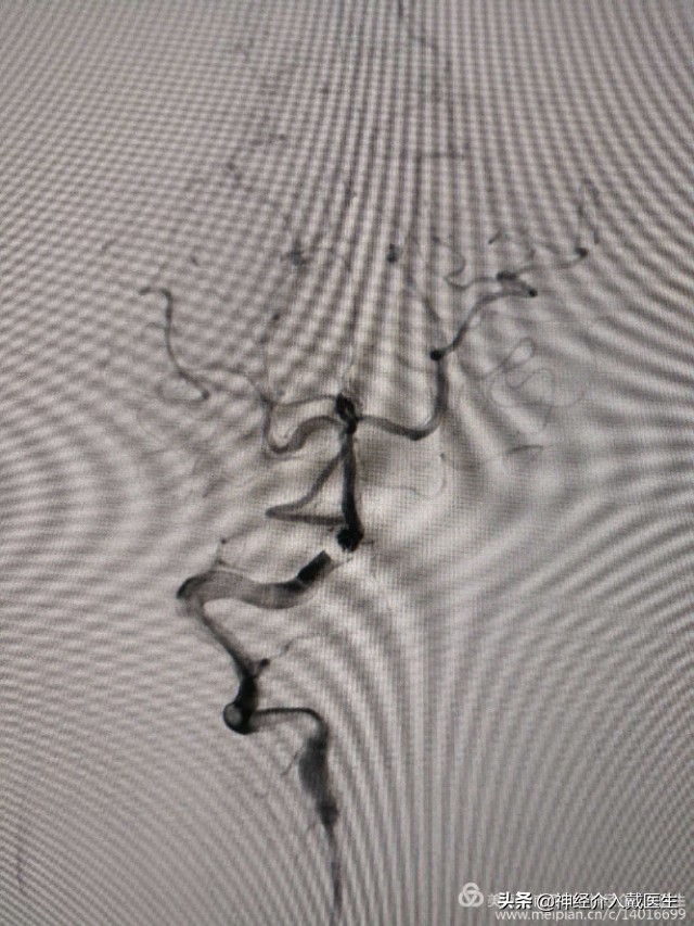 神经外科手术动脉瘤,湖南省人民医院脑动脉瘤介入治疗