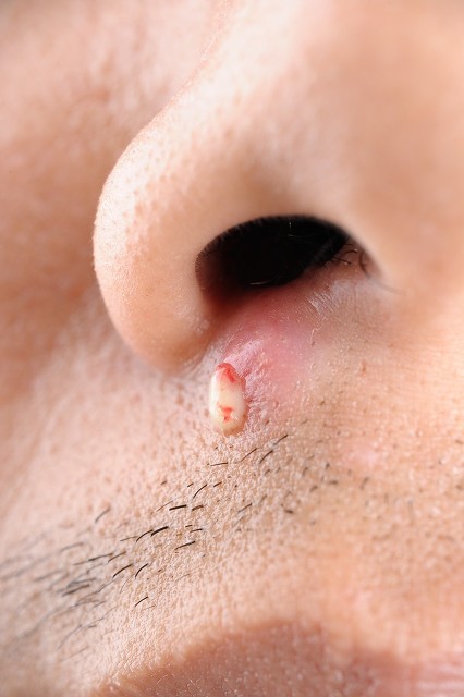 脓包有白色脓点能挤吗,痘痘挤出来的白色乳浆要挤吗