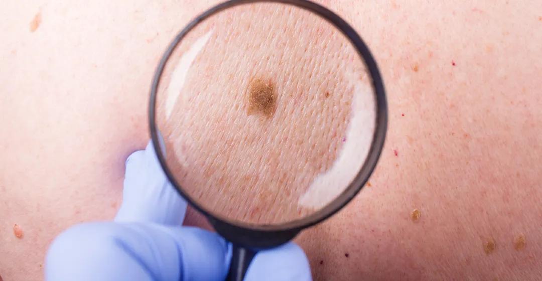 痣真的有那么大的癌变几率吗,痣会癌变真的很可怕吗