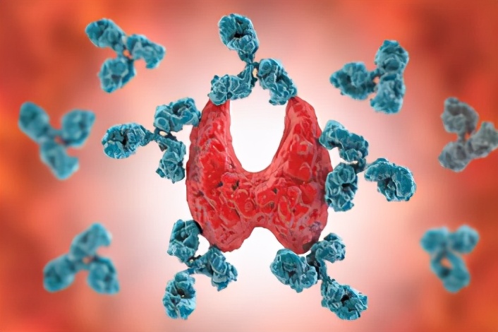 甲状腺囊肿2mm有什么症状和危害,甲状腺胶质潴留囊肿有哪些症状