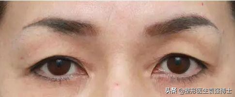 上眼皮松弛的解决办法,眼皮松了变成三角眼怎么解决