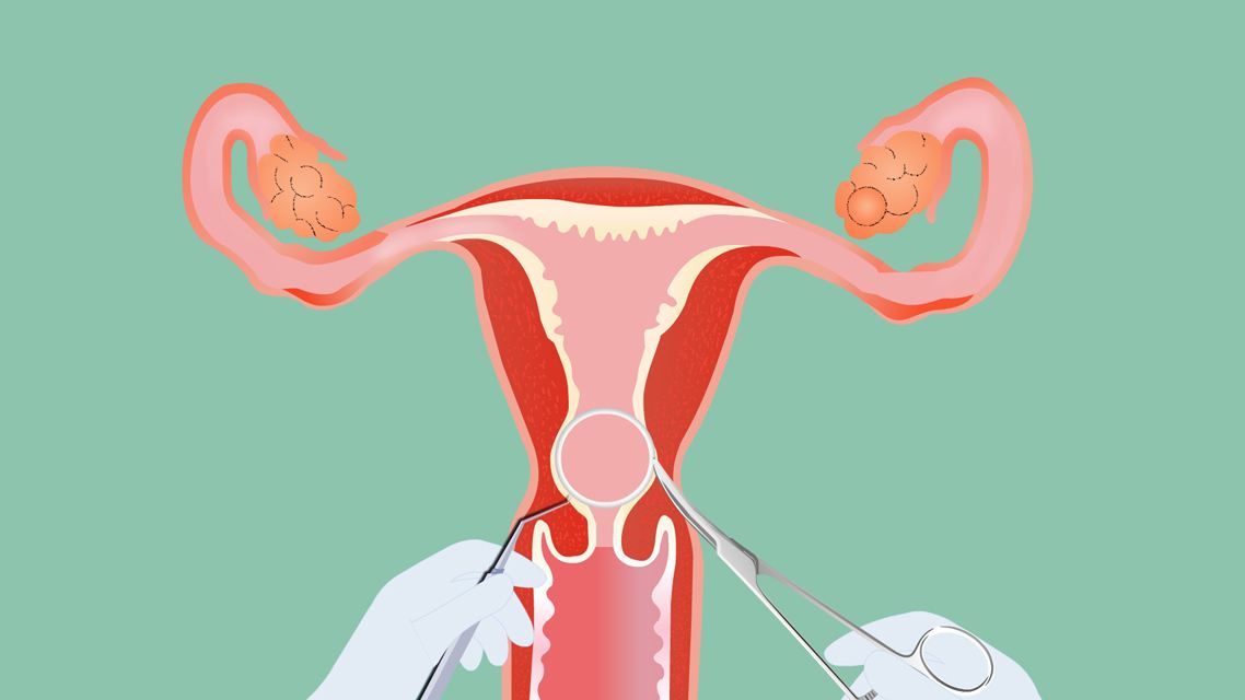 生完二胎上环还是结扎好,不上环怎样避孕最安全