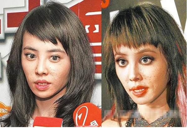 如何快速祛痘：痘痘分四个等级，你属于哪一级？