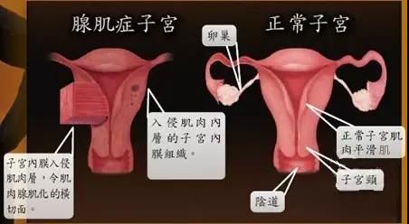 子宫异常出血的原因及注意事项,子宫异常出血和大姨妈有什么区别