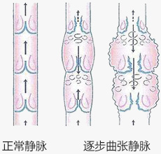 下肢静脉曲张出现皮疹用药,下肢瘙痒起疹子
