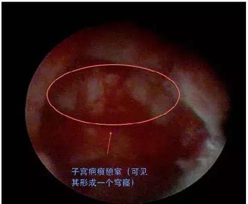 子宫憩室手术后怎么调理身体,子宫憩室手术后还会有憩室吗