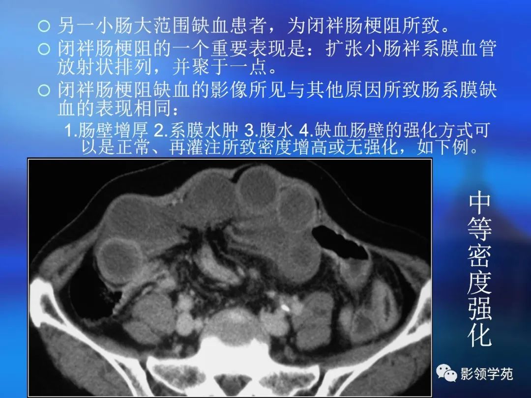肠道内壁增厚,肠道扩张ct表现