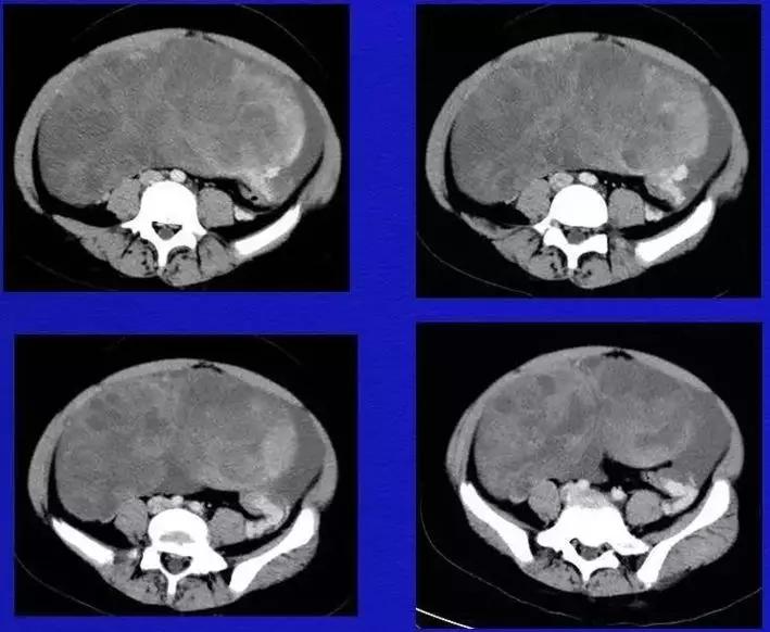 卵巢原发肿瘤的分析思路