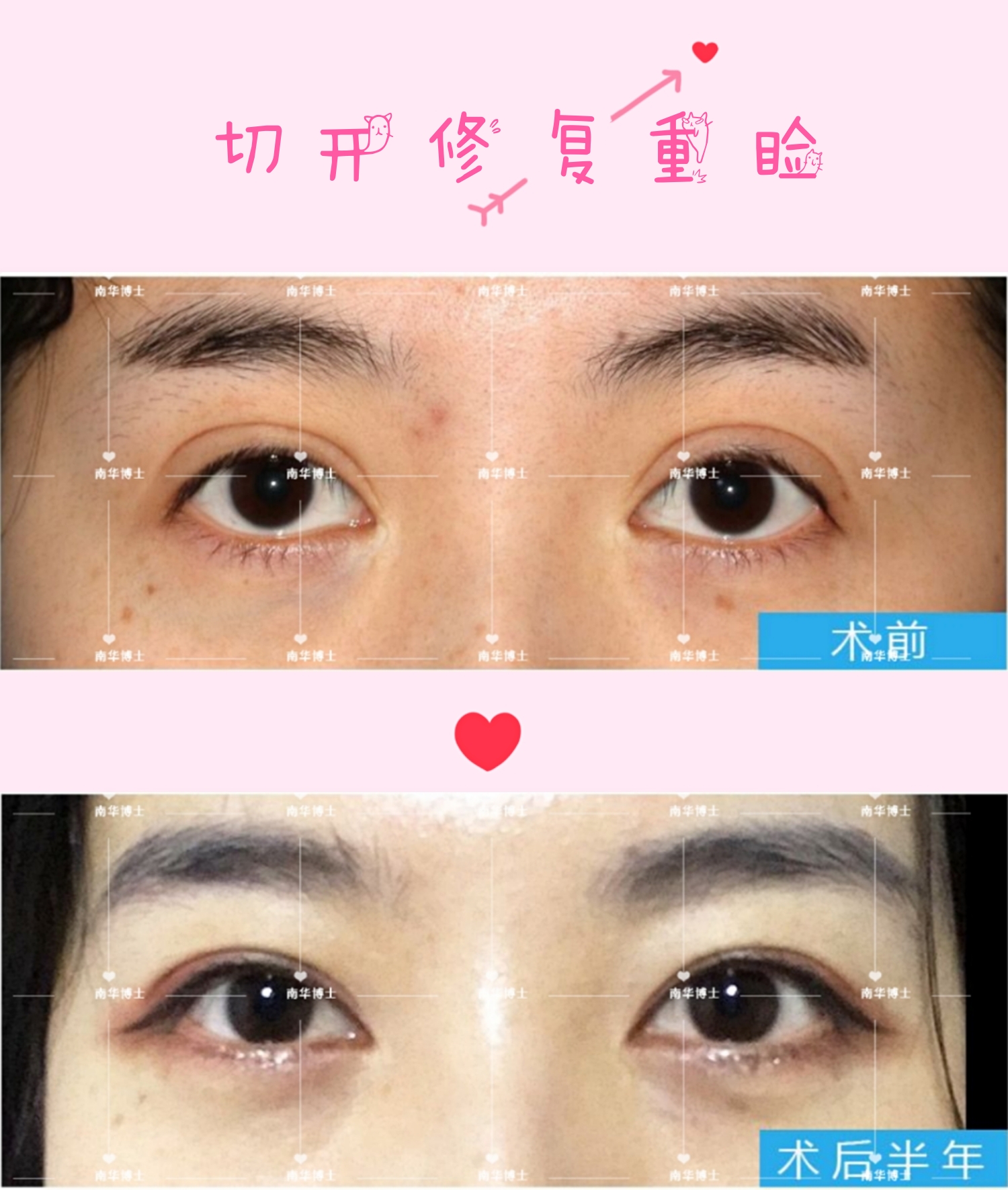 双眼皮不对称多久可以修复,全切双眼皮弧度不对称修复