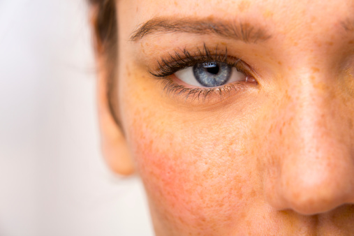 纯天然祛斑药,真正有效的祛斑药