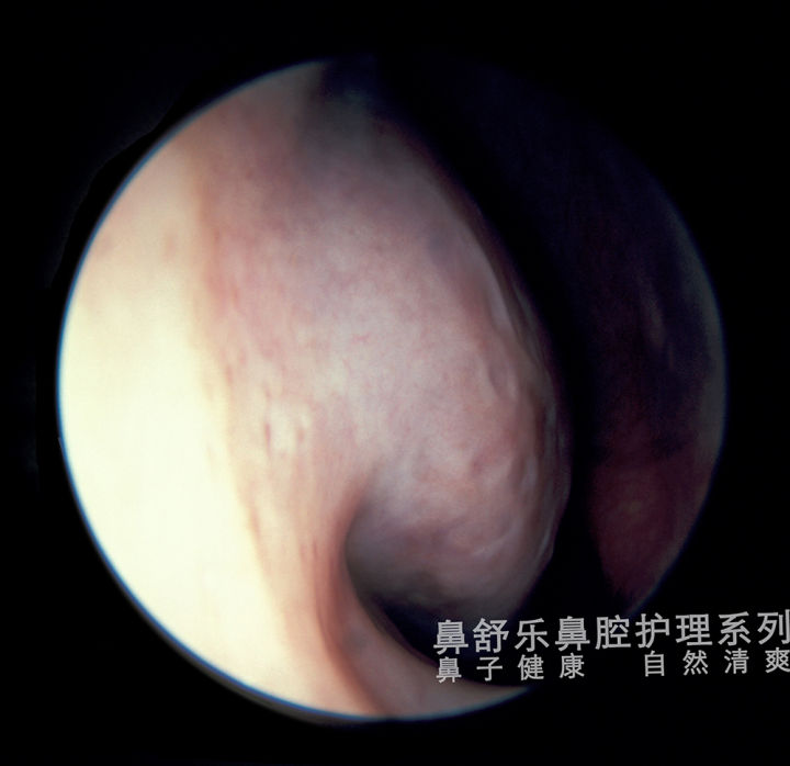 过敏性鼻炎可以彻底根治吗,过敏性鼻炎动手术能根治吗