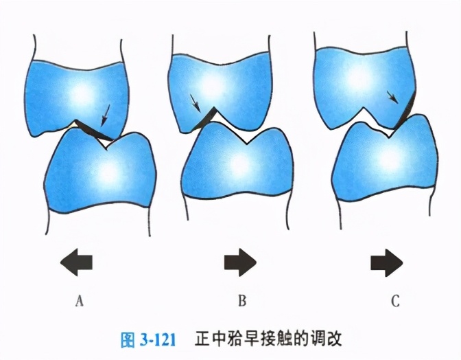 牙体缺损粘接修复术过程,口腔修复学牙体缺损的修复