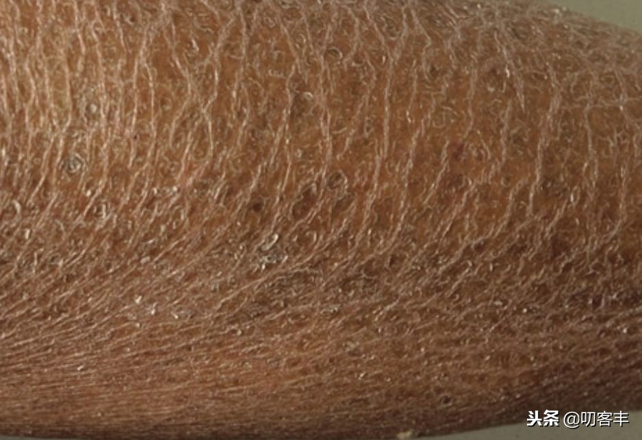 什么是鱼鳞病宝宝,什么是鱼鳞病