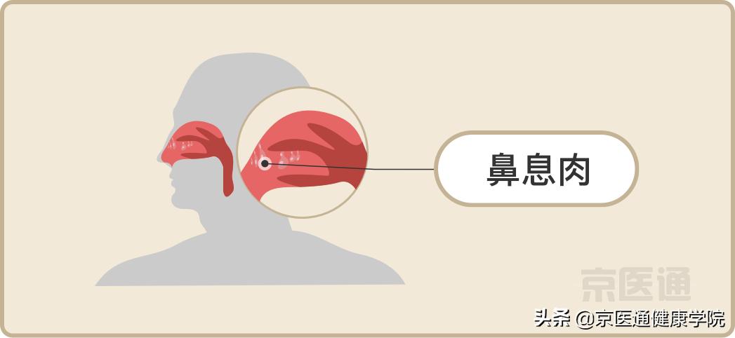 升结肠0.4息肉是癌的可能性是多少,胃体多发息肉0.2-0.4是癌吗