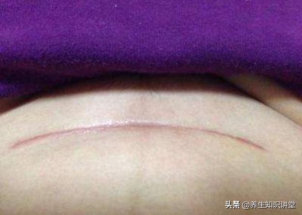 剖腹产疤痕和什么疤痕特别像,同样剖腹产为什么我特别痛