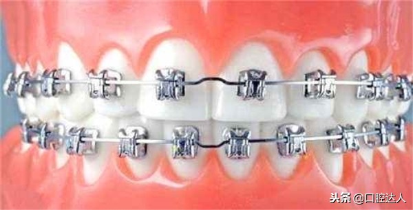 做了牙齿矫正反弹了,牙齿矫正后会反弹几率大吗