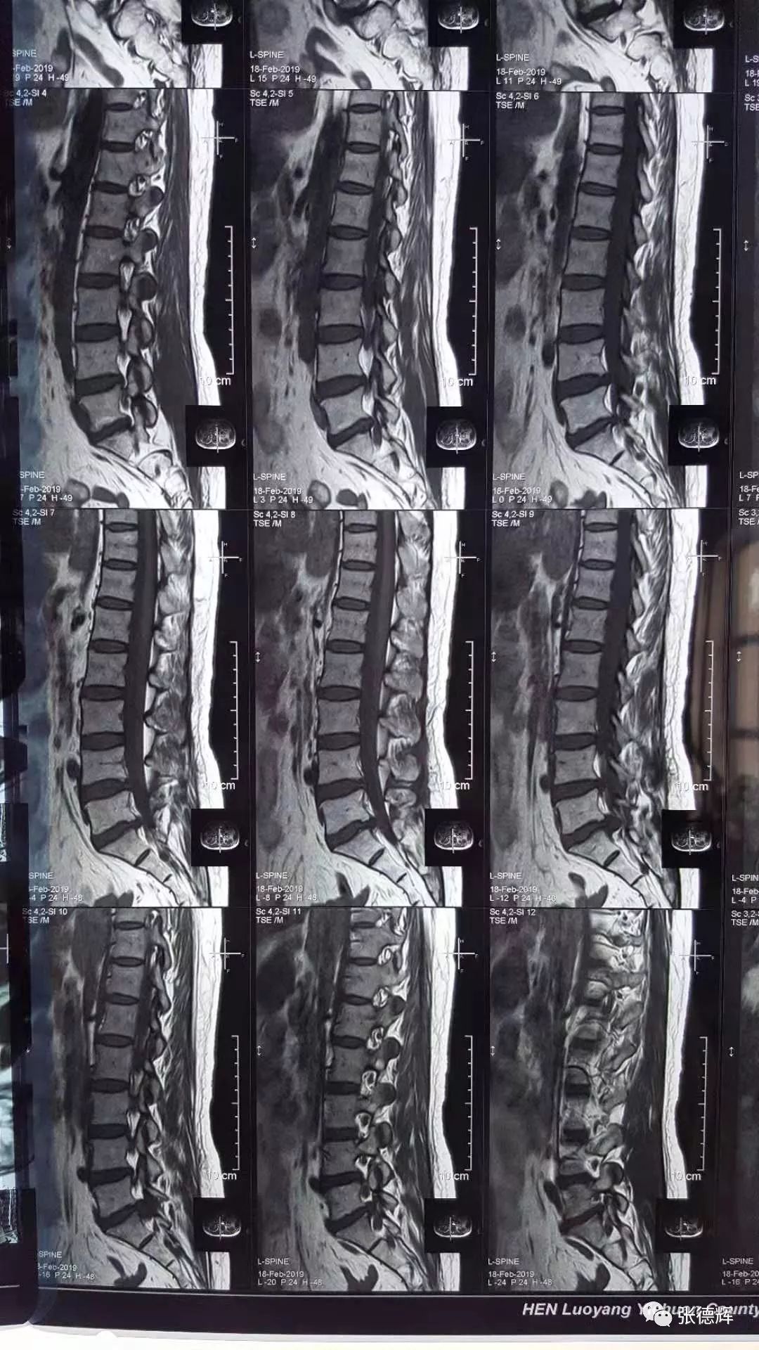 巨大腰间盘突出可以保守治疗吗,腰椎间盘突出不治疗越来越严重