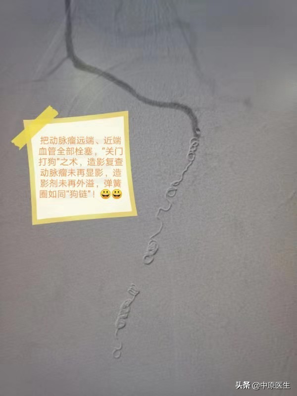 屁股上长个瘤怎么治疗,屁股上长了个瘤20多年了