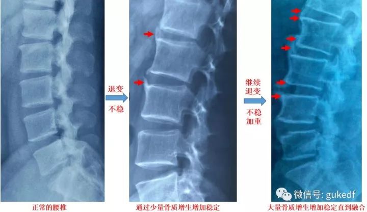长骨刺的根本原因是什么怎么解决,骨刺到底是不是病