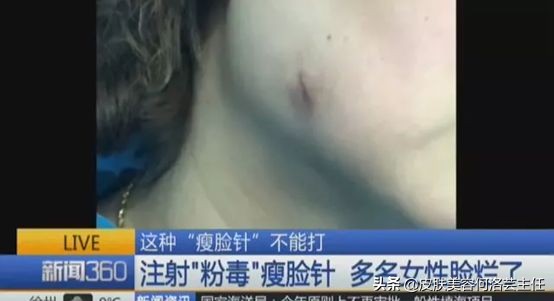 注射肉毒毒素针的危害,注射肉毒素的注意事项有哪些