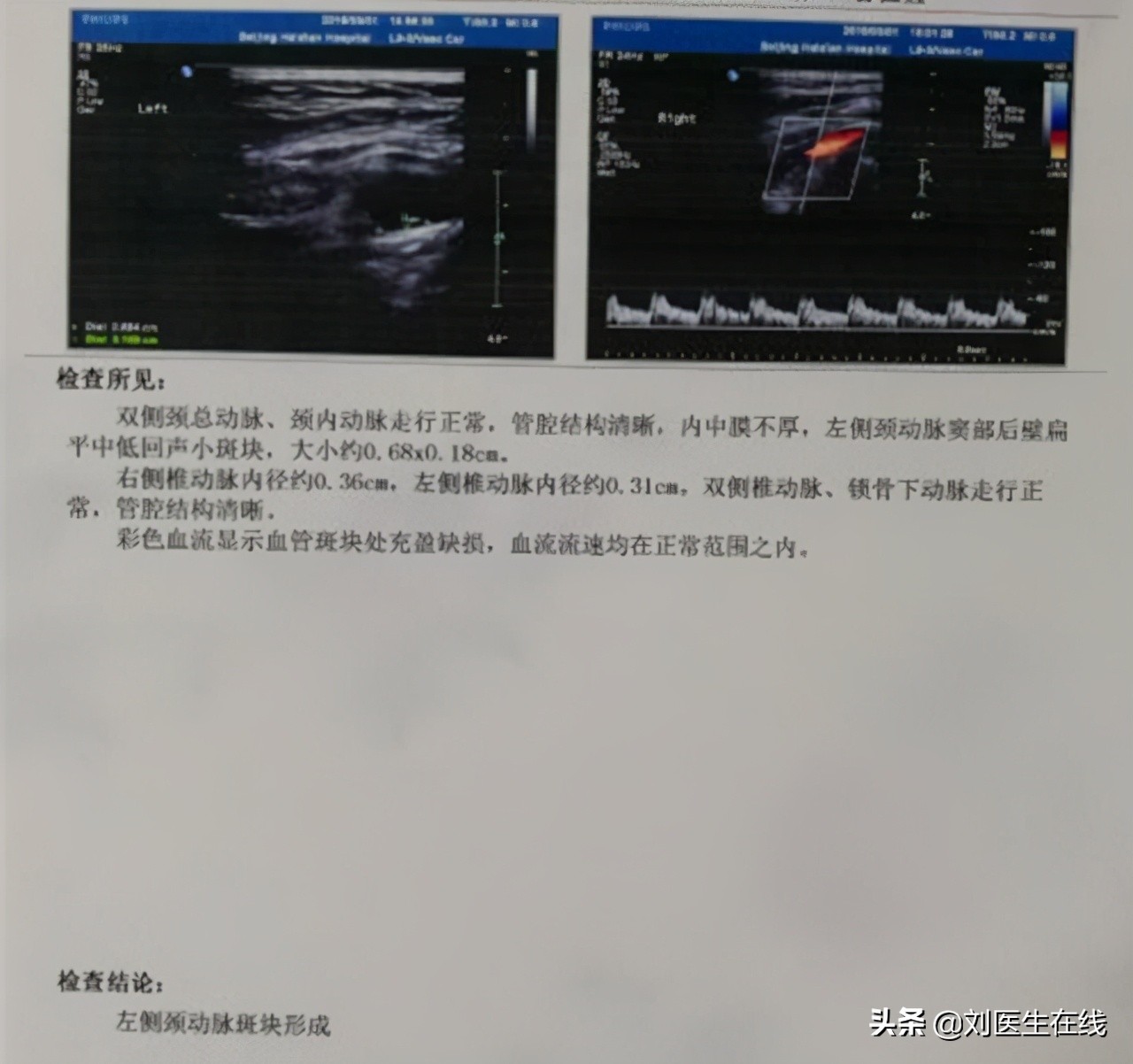 颈动脉有斑块就要吃他汀,颈动脉斑块究竟用不用吃他汀