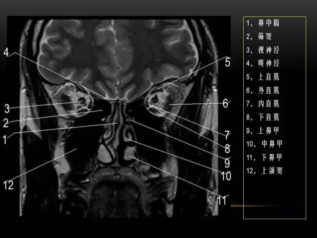 鼻腔鼻窦及颅底ct影像解剖,鼻窦解剖mri