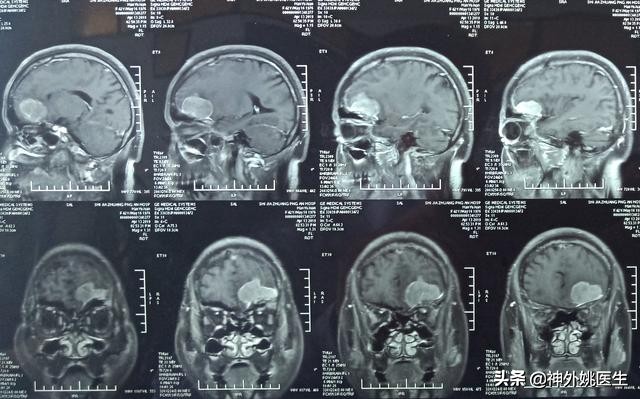 脑膜瘤是什么原因引起的啊,脑膜瘤手术治疗全部大概多少钱