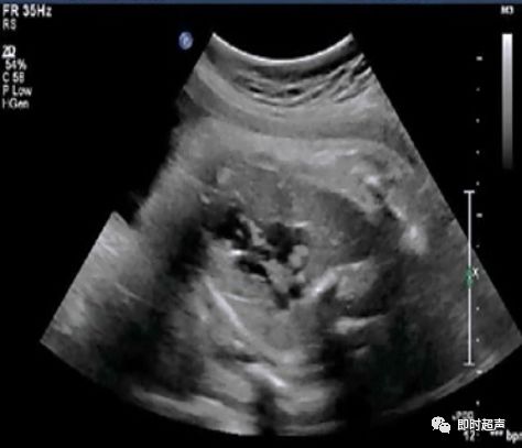 胎儿心脏三种血管关系模式图,25周的胎儿心脏弓切面多少正常
