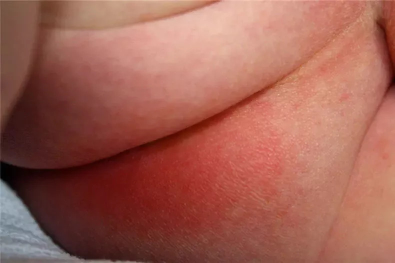 宝宝红屁股的救星,宝宝红屁股怎么办课件