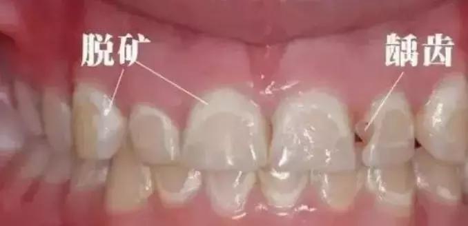 牙齿为什么有白斑点,牙齿脱矿白斑用涂氟剂可以修复吗