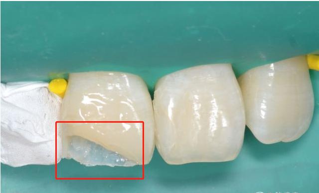 牙齿掉碎块的原因,牙齿掉渣是怎么回事