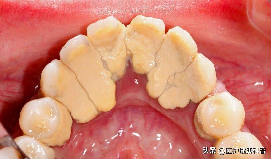 去除牙结石全过程解说,教你4个去除牙结石的小偏方
