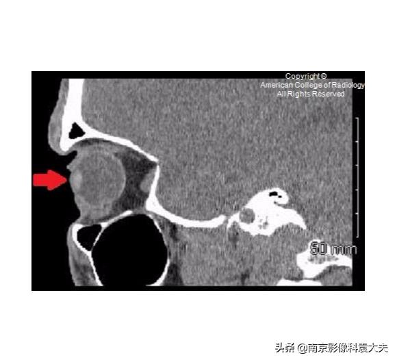 一39岁男子争吵后，右眼突然瞎了，病例分析知答案