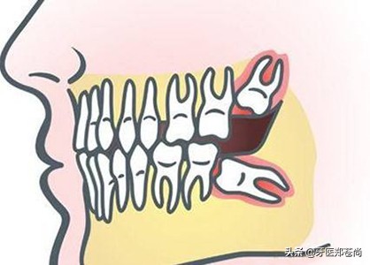 横着长的智齿一定要拔吗要疼多久,智齿横着长压着神经线拔有风险吗