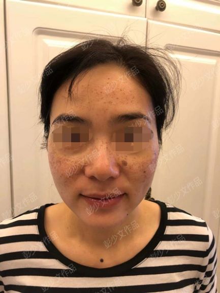 祛雀斑效果最好的方法,谁有亲身体验过的祛雀斑方法