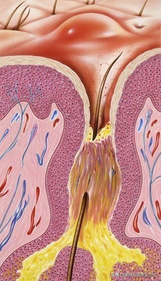 脸上痤疮用哪种外用维a酸类药物,治疗痤疮的维a酸类药