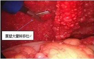 热疗43度能杀死癌细胞吗,43度恒温治疗癌症