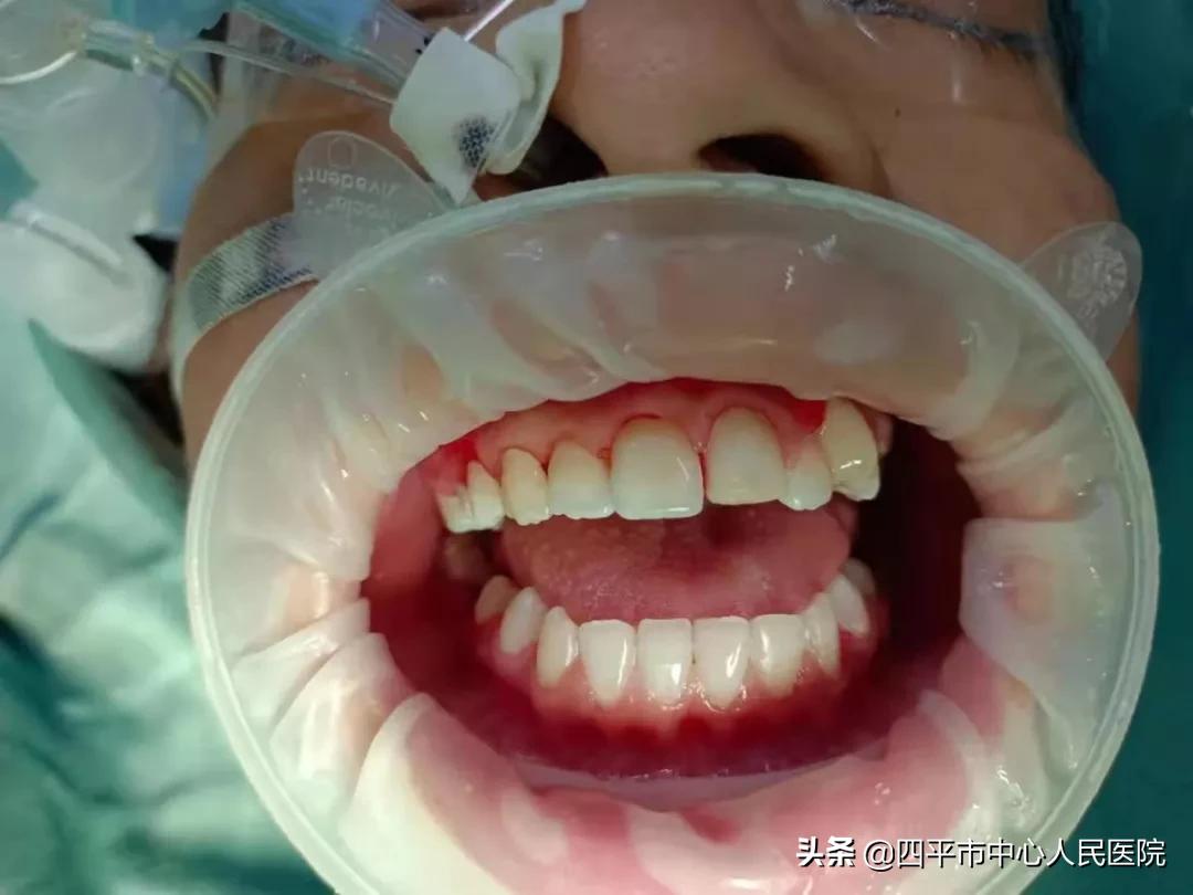 使用这个方法让孩子告别蛀牙,告别蛀牙洞