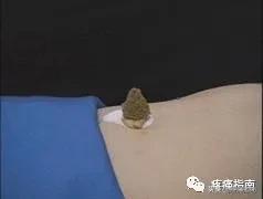 隔姜灸可以治痛经吗,寒湿凝滞型痛经吃什么中药