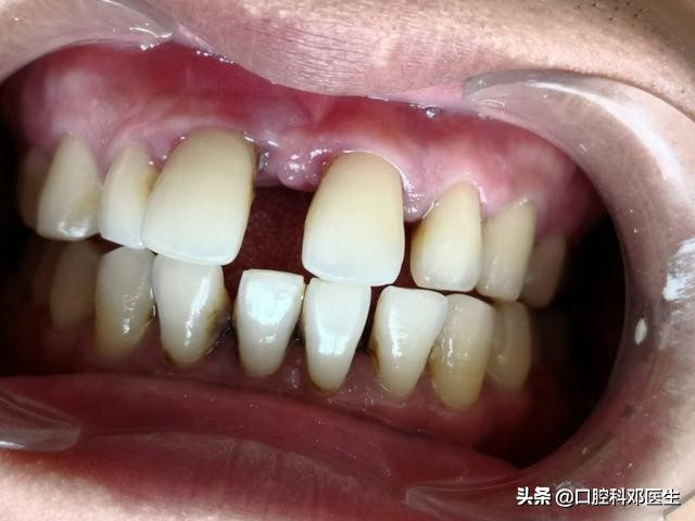 牙周炎导致门牙缝隙大,牙周炎引起门牙缝隙变大