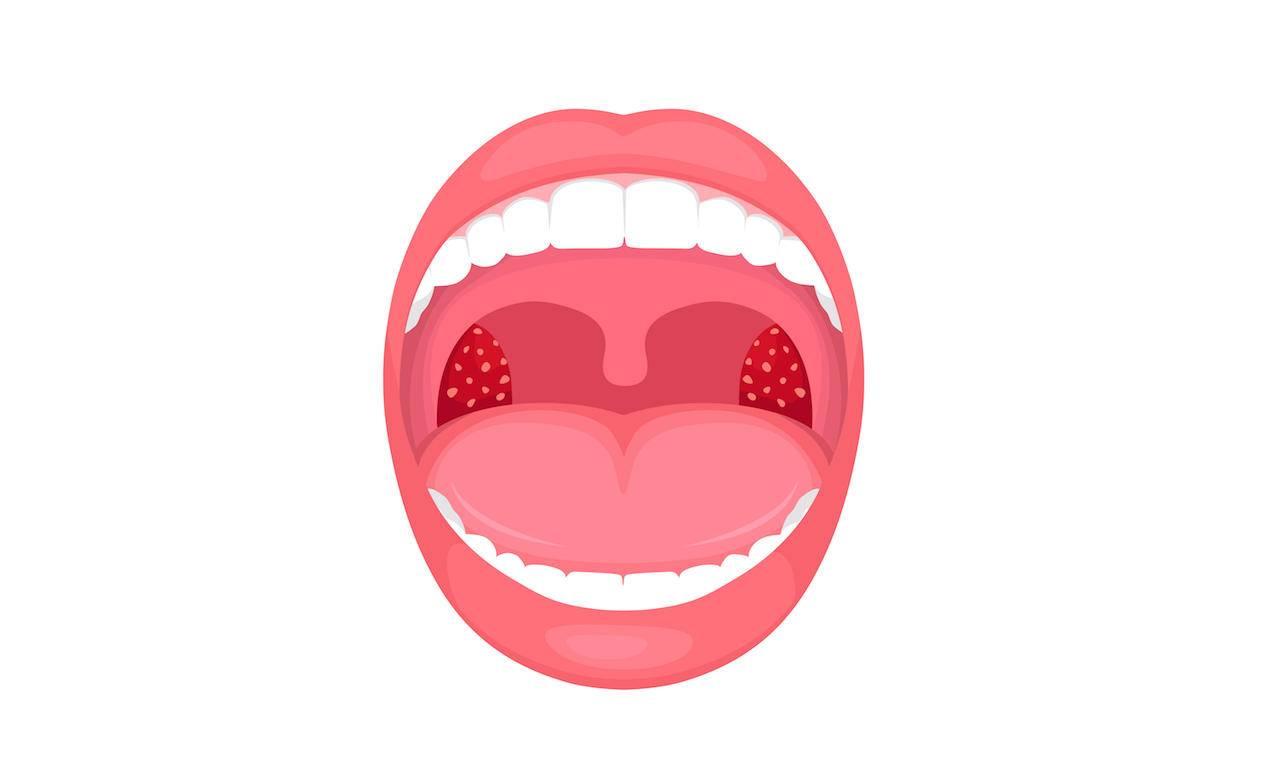 化脓性扁桃体炎怎么治疗好得快,婴儿扁桃体炎的症状和治疗方法