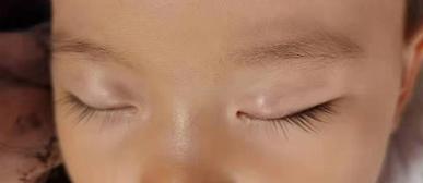 一岁多宝宝霰粒肿康复过程全纪录