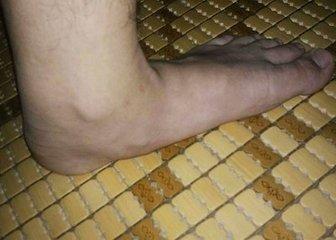 西安治疗扁平足最好的医院,扁平足拇指外翻的治疗方法